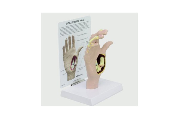 model dłoni z chorobą zwyrodnieniową stawów - 1019520 3b scientific modele anatomiczne 2